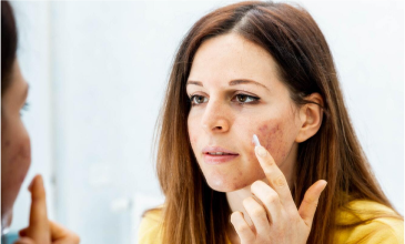 What Is Acne? Symptoms, Causes, Treatments