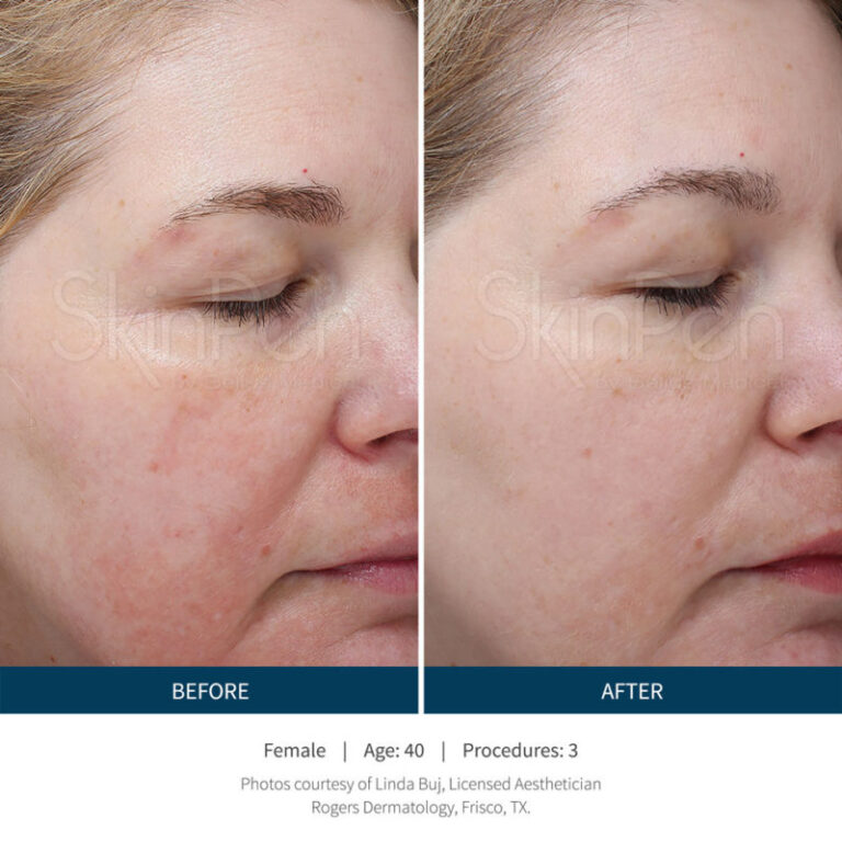 microneedling-before-1