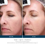 picroneedling-2