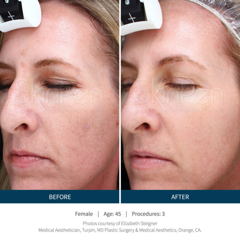 picroneedling-2