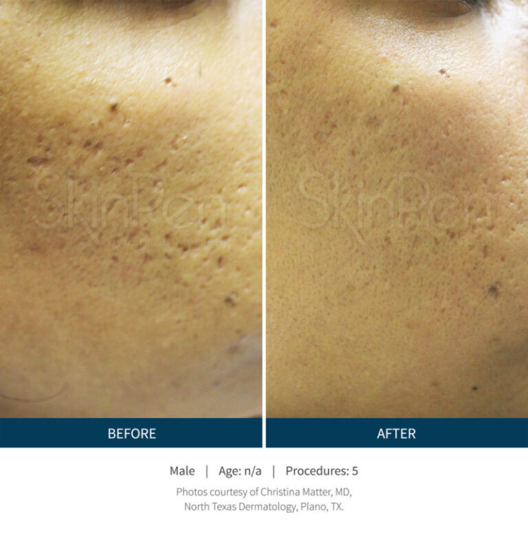 skinpen-female-before-after-3