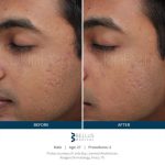 skinpen-male-before-after-1