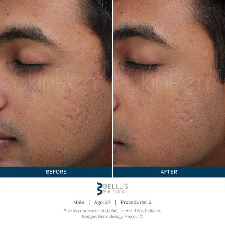 skinpen-male-before-after-1